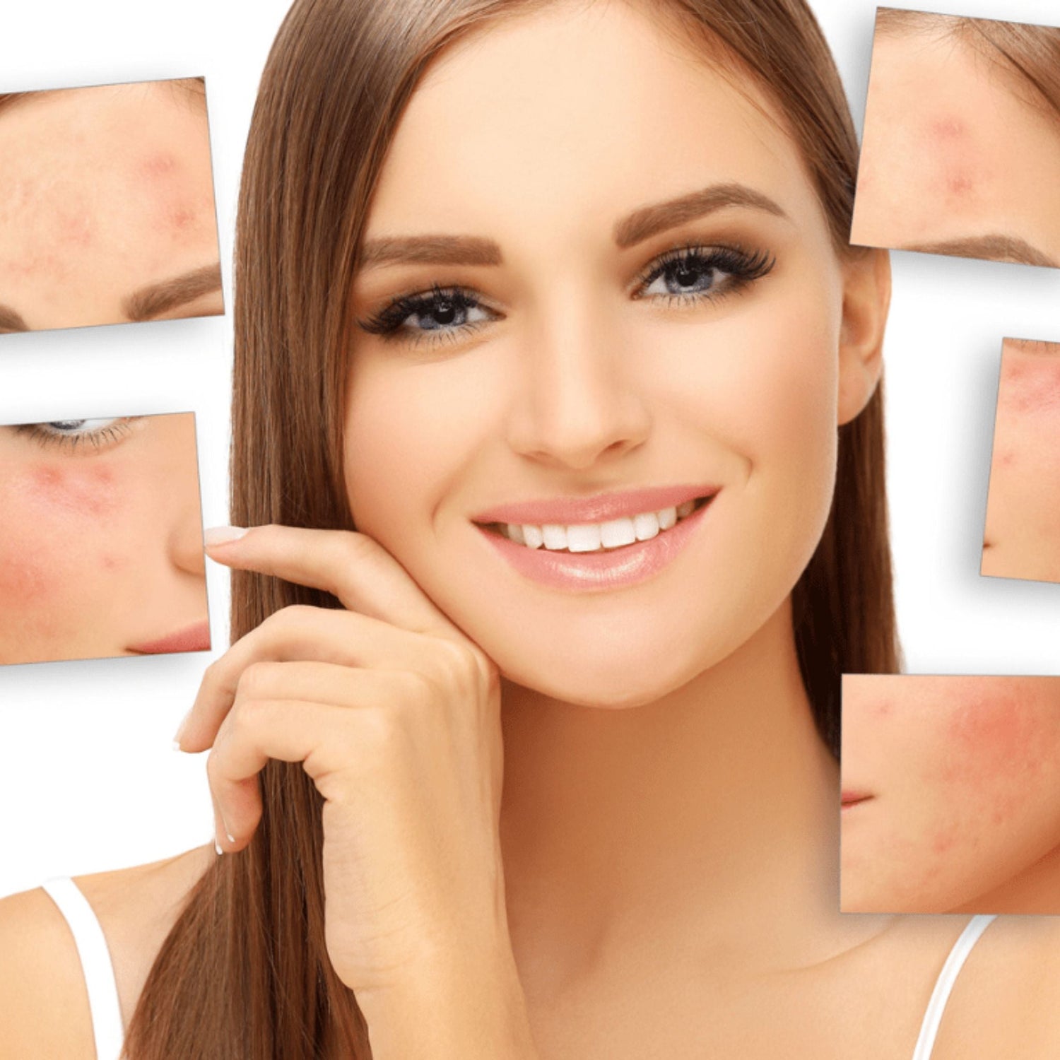 Close-up of a smiling girl with clear, radiant skin, pointing to snippets of her previous pimpled complexion, showcasing the effective transformation achieved with natural skincare solutions.