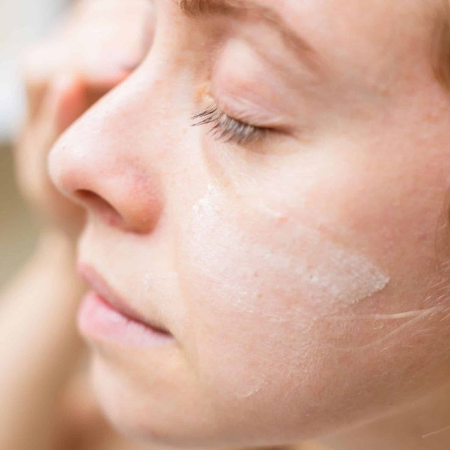 A woman with dermatitis on her face, eyes closed, with soothing treatment cream applied. She appears relieved, highlighting the calming and hydrating effects of natural skincare for sensitive skin.