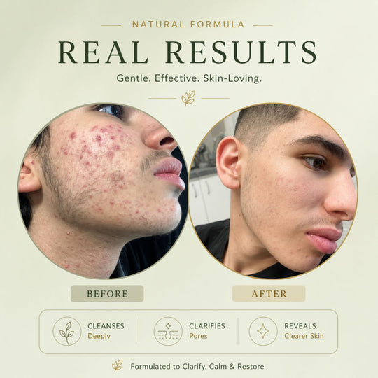 Before and after comparison showing clearer-looking skin following use of Bubble Clinic 2% BHA Zinc Pyrithione Cleanser. Premium skincare results image featuring reduced visible blemishes, calmer-looking skin and a more even complexion after consistent use of the natural formula.