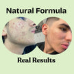 photo shot of before and after treatment of real user showing lots of inflamed hormonal acne prior to treatment and cleared skin in after image.