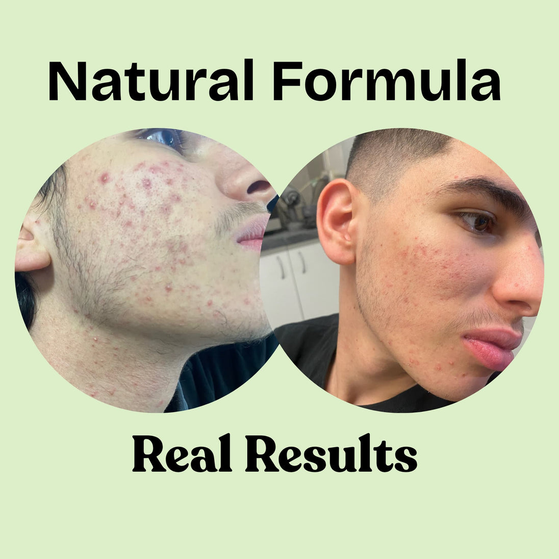 photo shot of before and after treatment of real user showing lots of inflamed hormonal acne prior to treatment and cleared skin in after image.